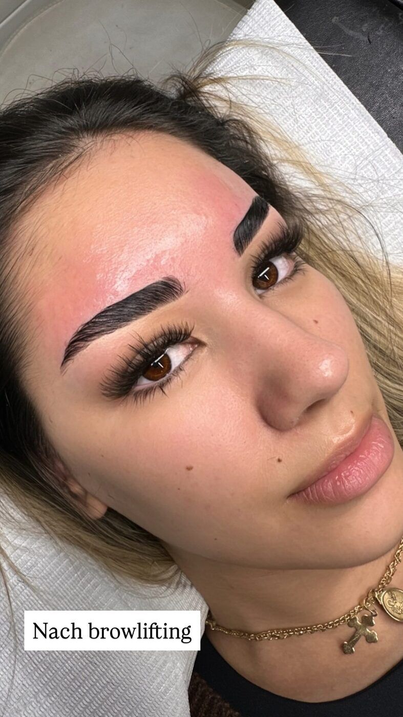 Browlifting – nachher